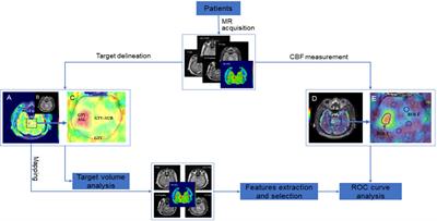 Three-Dimensional Arterial Spin Labeling-Guided Sub-Volume Segmentation of Radiotherapy in Adult Non-Enhancing Low-Grade Gliomas